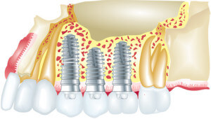 Tooth implants