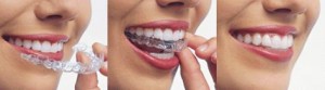 Invisalign